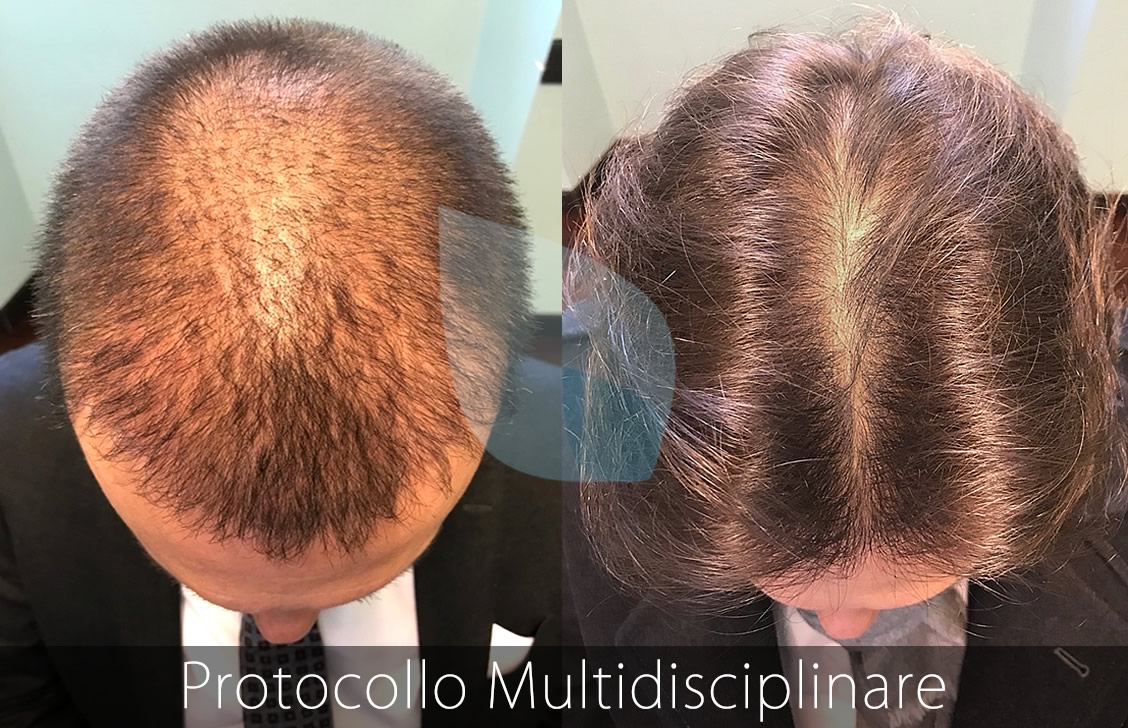 bSBS Capelli, PRP Capelli, hCRP Capelli, Calvizie