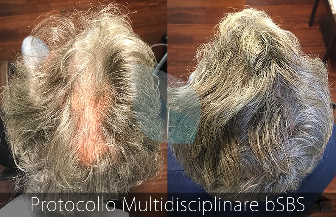 bSBS Capelli, PRP Capelli, hCRP Capelli, Calvizie, Deressione e Alopecia, Capelli