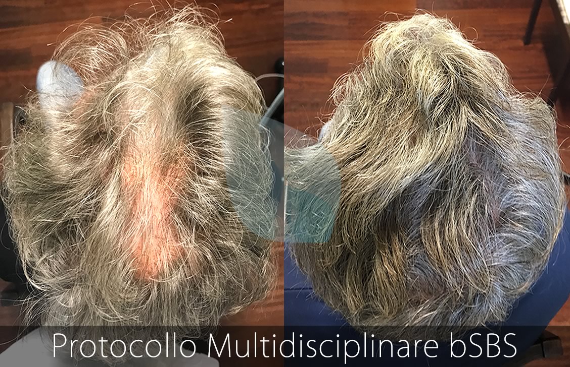 bSBS Capelli, PRP Capelli, hCRP Capelli,Cibi che prevengono la Calvizie