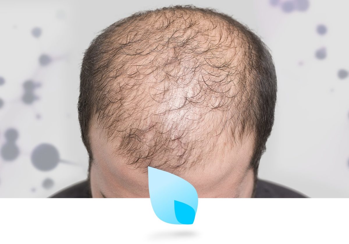 Cura Alopecia Universale, Calvizie scoperta nuove molecole