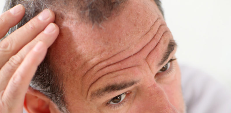 A quale età inizia la Alopecia?