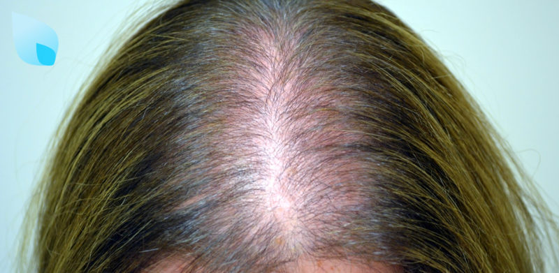 Alopecia Femminile