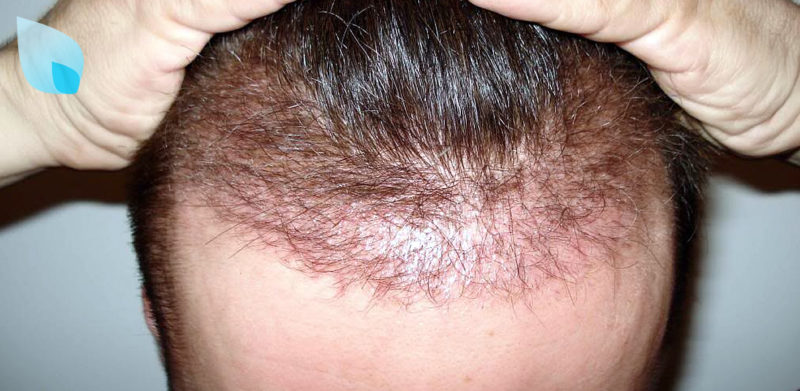 Alopecia Infiammatoria Post Trapianto