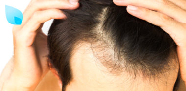 Alopecia e Diradamento
