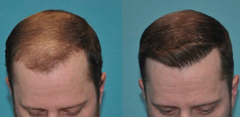 Alopecia e Stempiatura