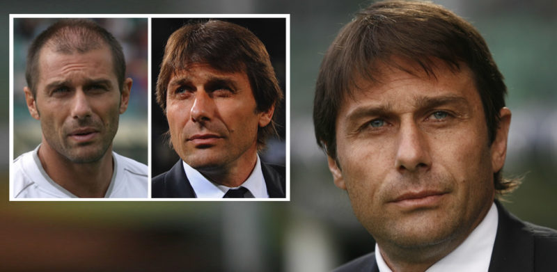 Autotrapianto Capelli Conte