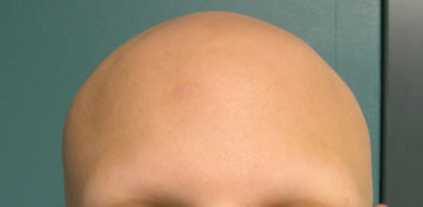Cura Alopecia Universale