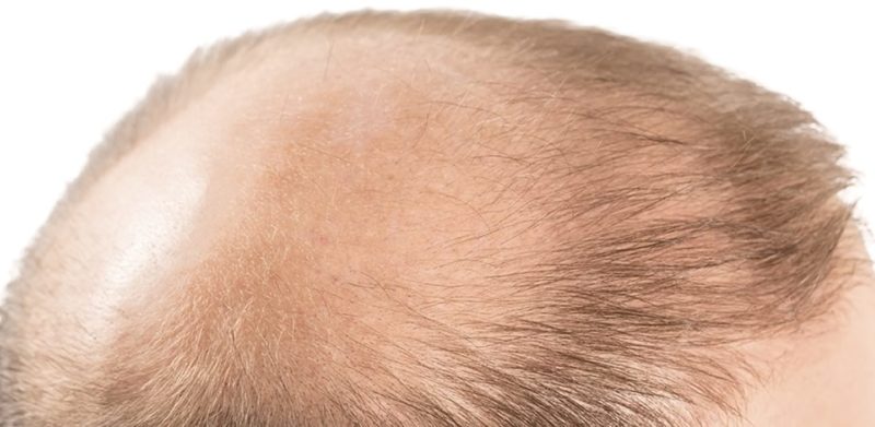 Perché il trapianto di capelli non funziona?