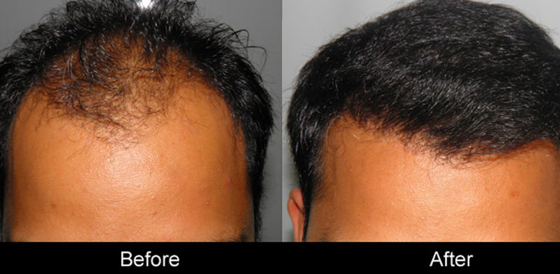 Trapianto Capelli Udine