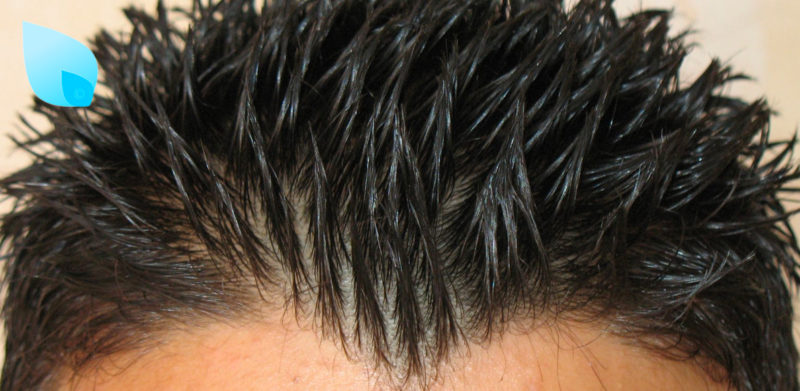 Trapianto Capelli Verona