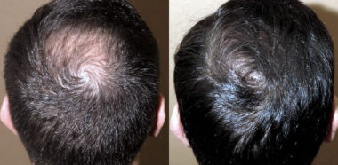 Alopecia e Calvizie