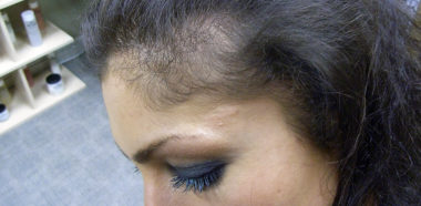Caduta dei capelli e alopecia femminile