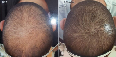 Calvizie e Cellule Staminali