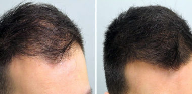 HairCarbokyTherapy e PRP