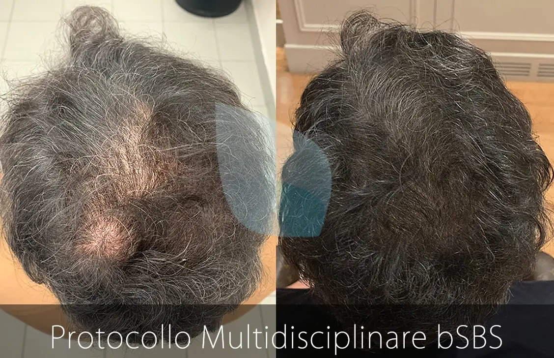 bSBS Capelli, PRP Capelli, hCRP Capelli, autotrapianto capelli