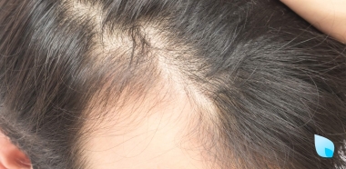 diradamento capelli causa cura Protocollo bSBS