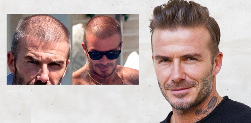 Beckham Capelli DavidBeckham ieri oggi-rigenerazione cellulare HairClinic