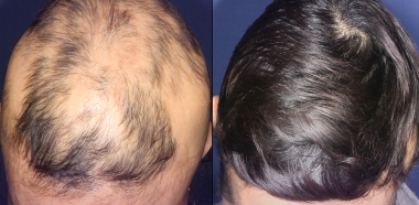 cura alopecia areata 2023
