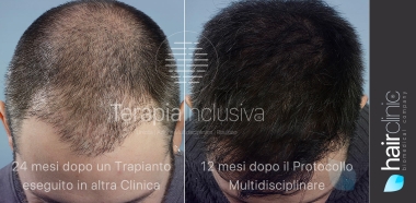 Trapianto di Capelli 2023