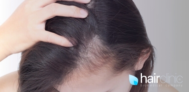 alopecia-femminile-come-combatterla