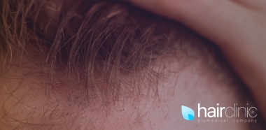 alopecia-iatrogena-da-farmaci-sintomi-cause-rimedi-cura