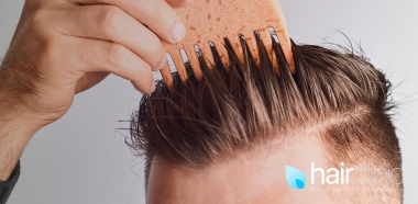 trapianto-di-capelli-risultati-dopo-quanto