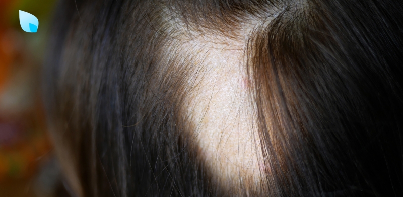 alopecia-areata-sintomi-cause-cura-rimedi