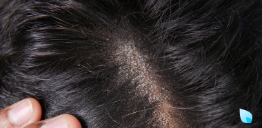 dermatite-seborroica-cuoio-capelluto-caduta-dei-capelli