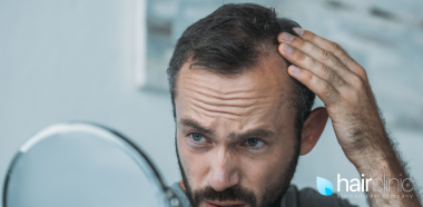 uomo con alopecia che si guarda allo specchio preoccupato