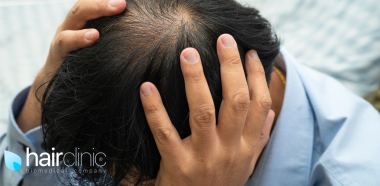 uomo che tiene le mani sui capelli radi