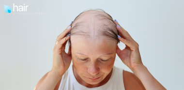 donna affetta da alopecia