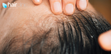 dita che attraversano una cute dai capelli radi