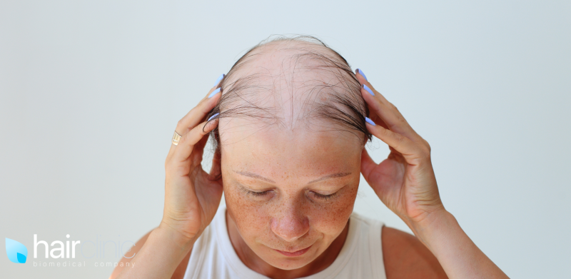 donna con alopecia areata