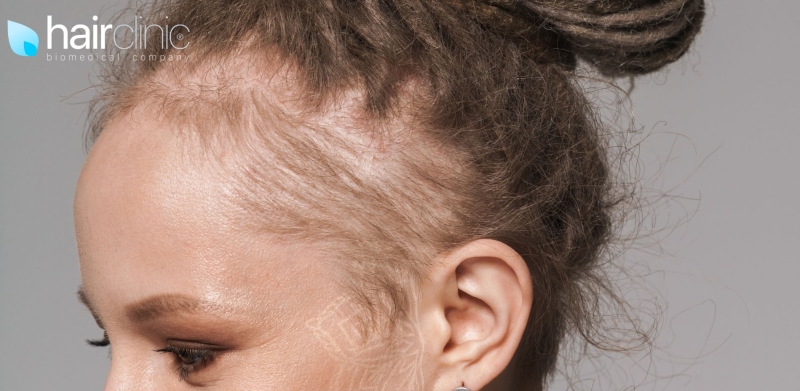 donna con i rasta e alopecia da trazione