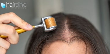 donna e il microneedling per capelli