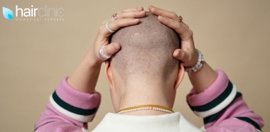 donna calva vista da dietro si tiene la testa