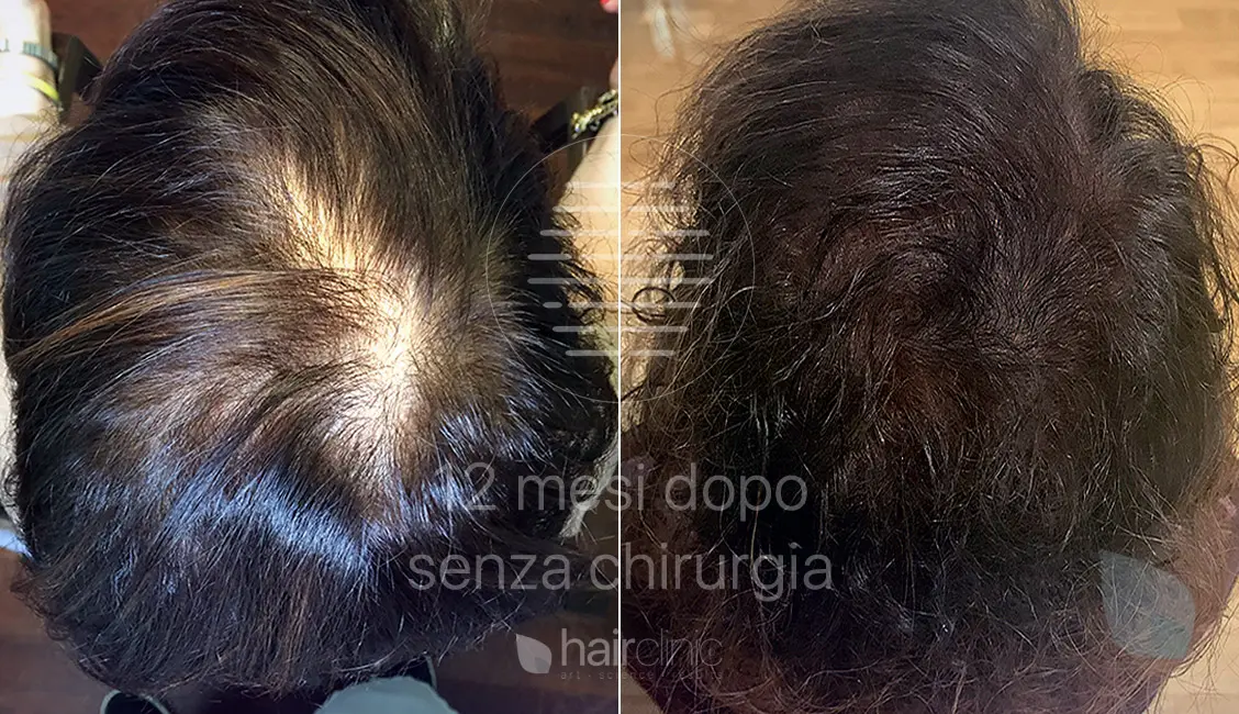 autotrapianto capelli dopo la cura