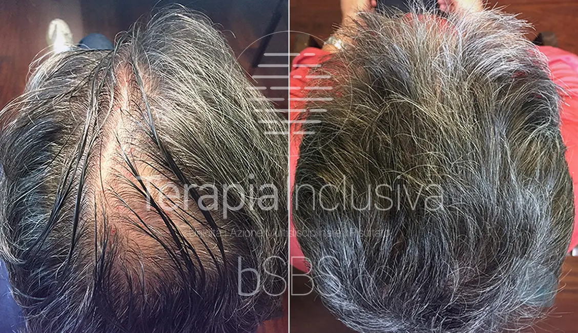 trapianto capelli prima e dopo risultati hair clinic