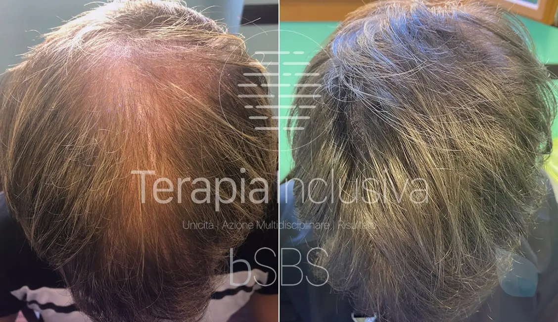 Trapianto Capelli Risultati