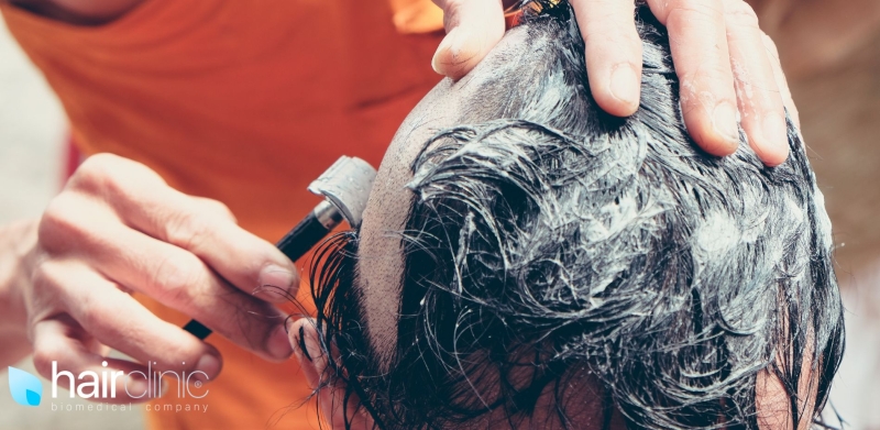 man being shaved because of alopecia