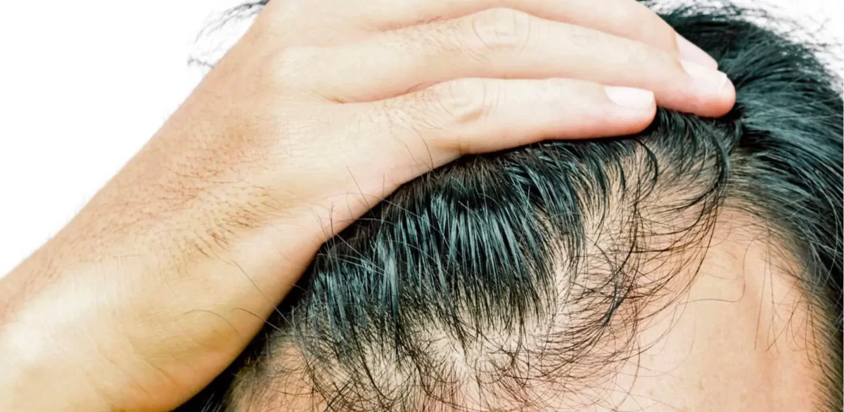 Perdere i capelli a 20 anni