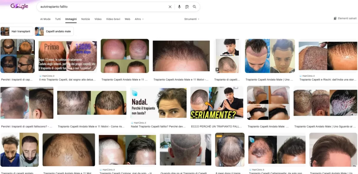 Trapianto capelli in Turchia fallito dopo uno o due anni