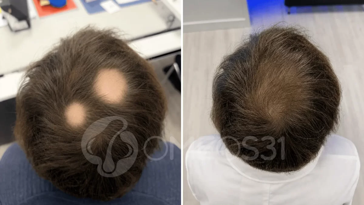 alopecia areata cura